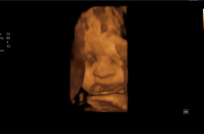 Ecografía Obstétrica 3D