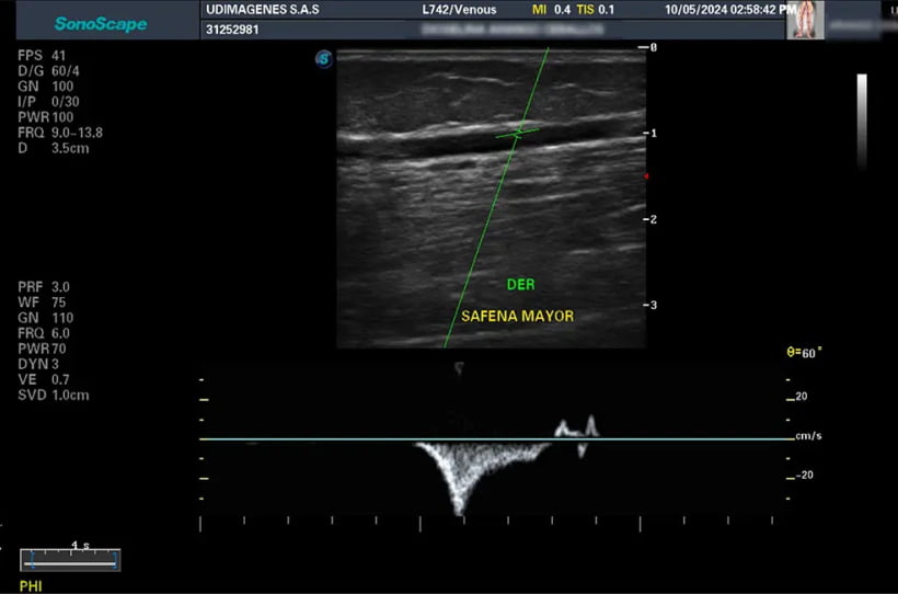 Ecografía Doppler Color